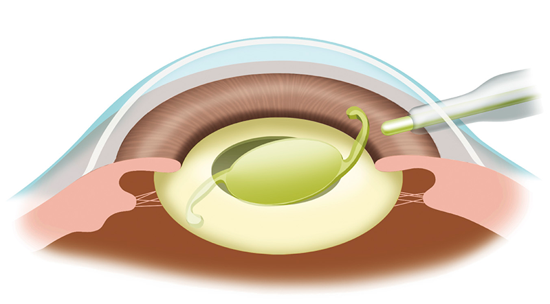 眼内レンズを挿入